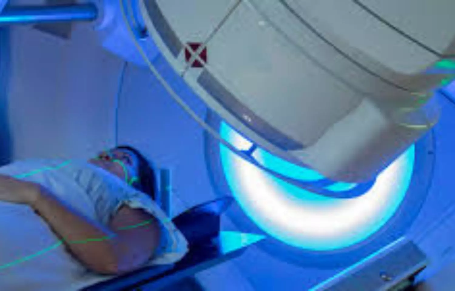 Radiation therapy after surgery safely reduces pelvic relapse risk from locally advanced, muscle-invasive bladder cancer: Study