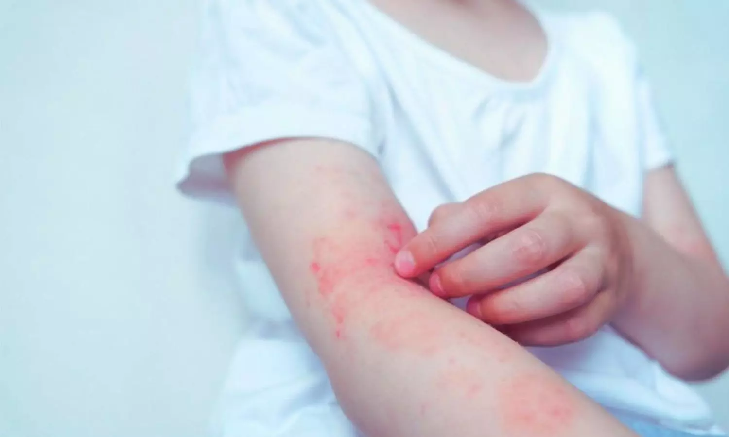 Acitretin and Methotrexate Outperform Cyclosporine in Pediatric Psoriasis Maintenance: Study Shows