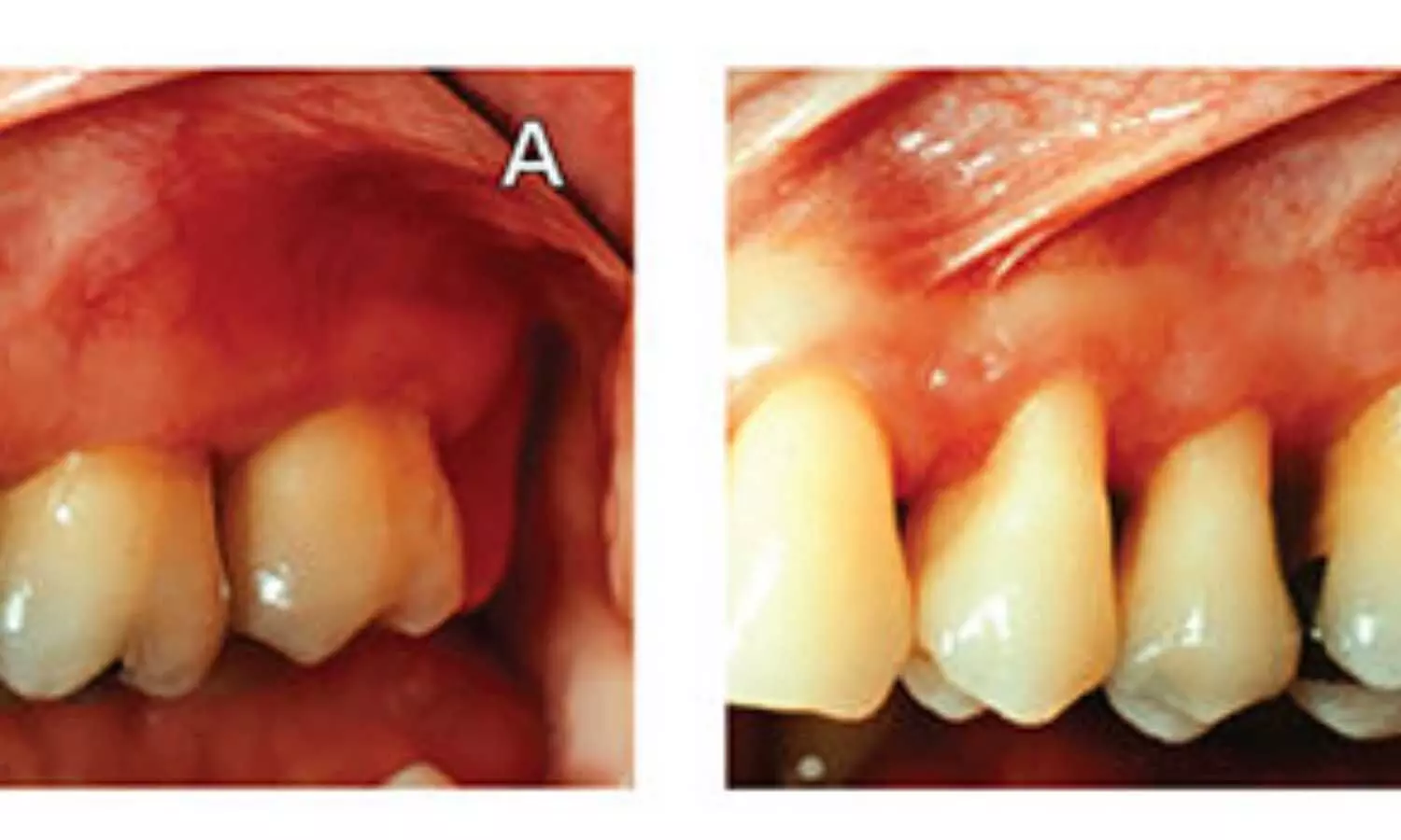 Diabetes Increases Risk of Oral and Maxillofacial Diseases: Study