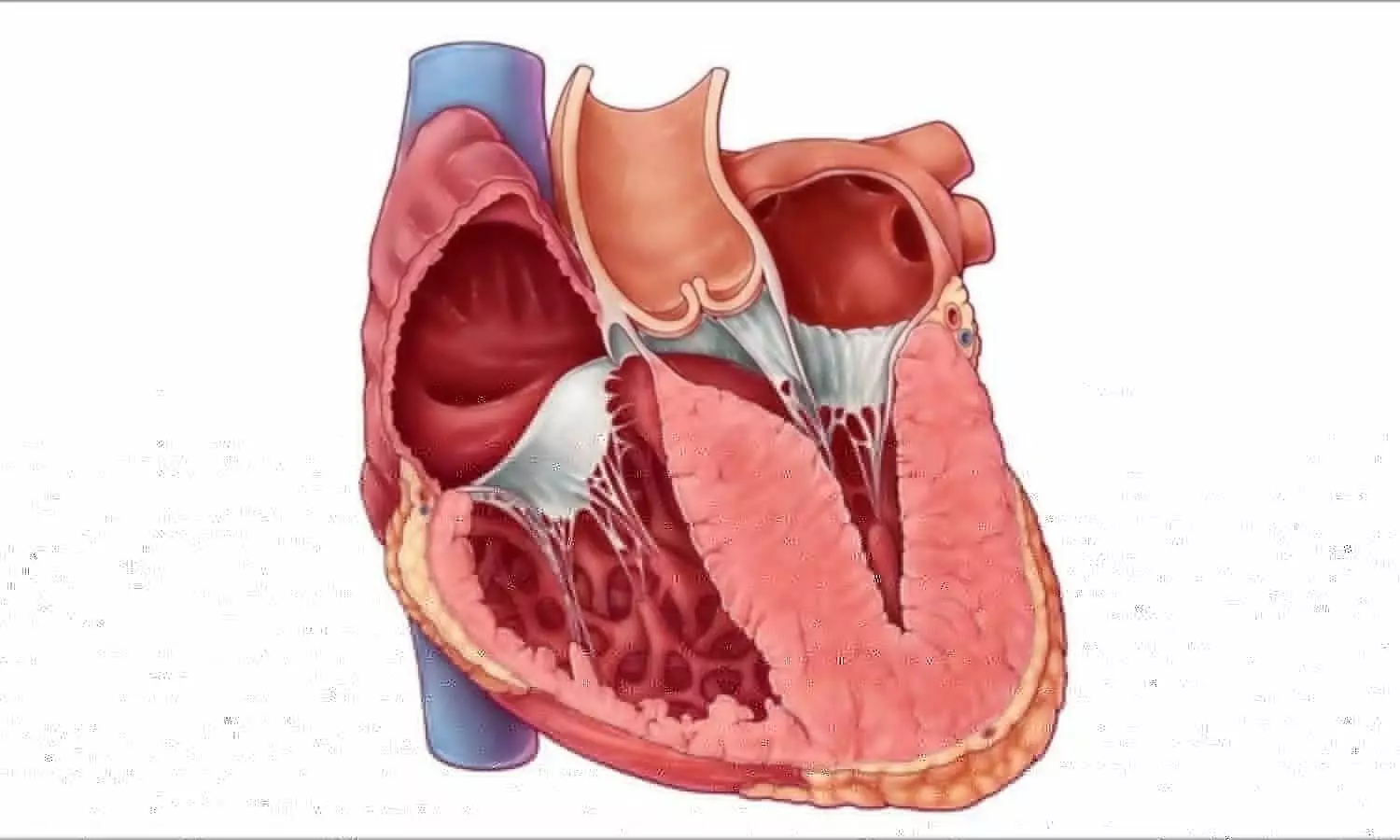 Diabetes Significantly Worsens Outcomes in Hypertrophic Cardiomyopathy, Meta-Analysis Finds
