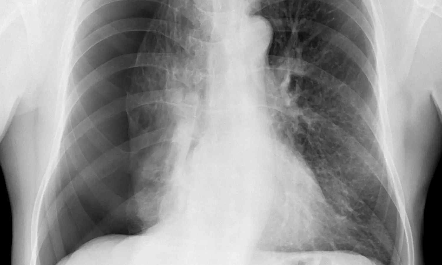 Pleural Abrasion Favored for Faster Recovery; Pleurectomy Reduces Recurrence Risk in Spontaneous Pneumothorax: Study