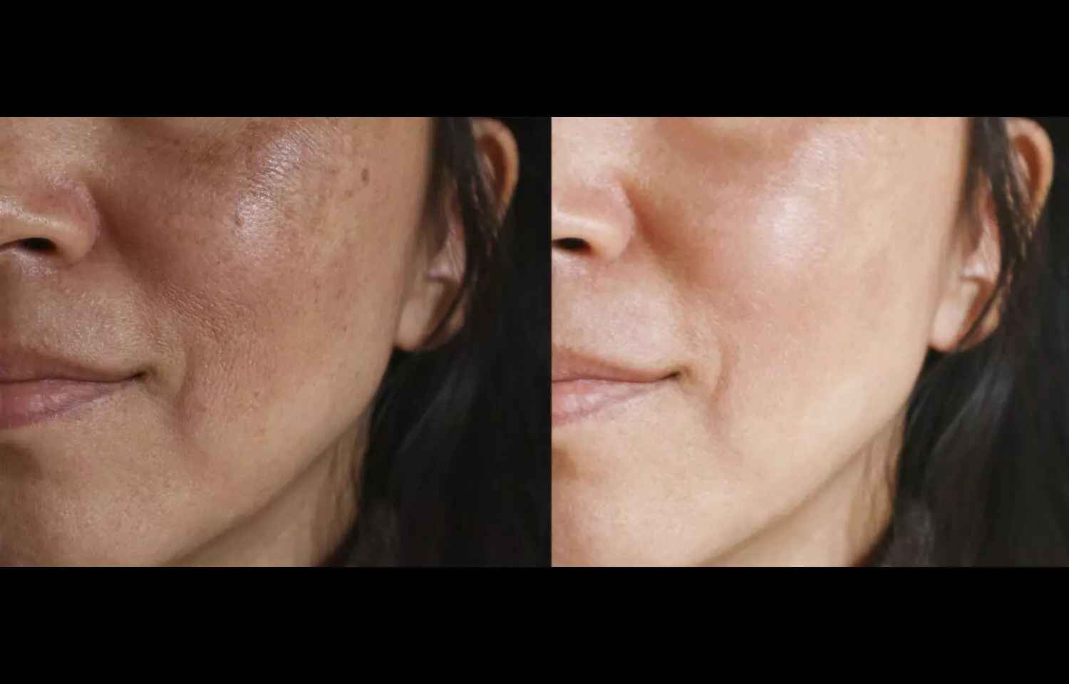 Oral vs. Topical TXA: Comparable Effectiveness and Safety in treatment of Melasma