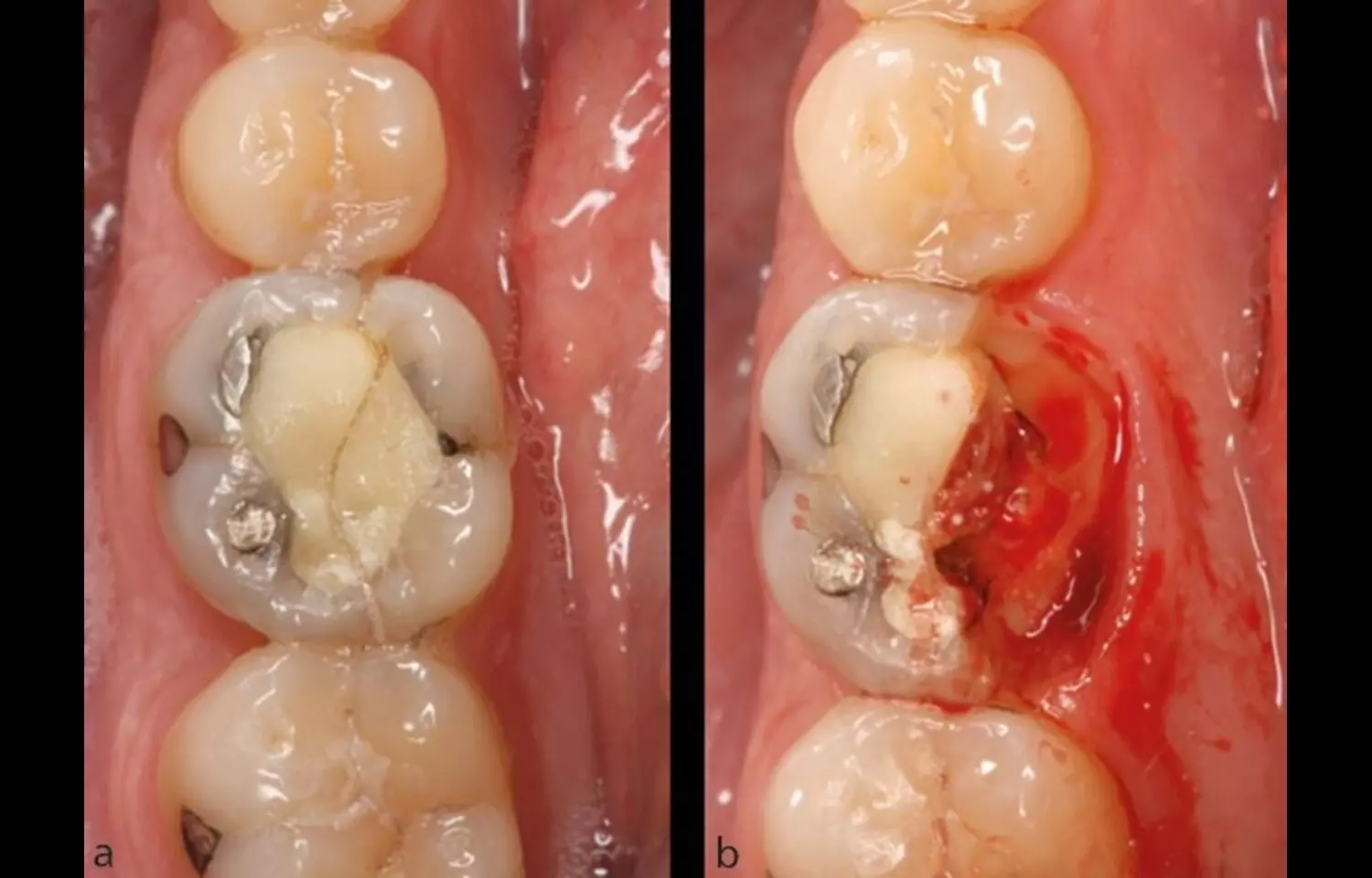Timing of Restoration After RCT Does Not Impact 5-Year Outcomes, suggests Study