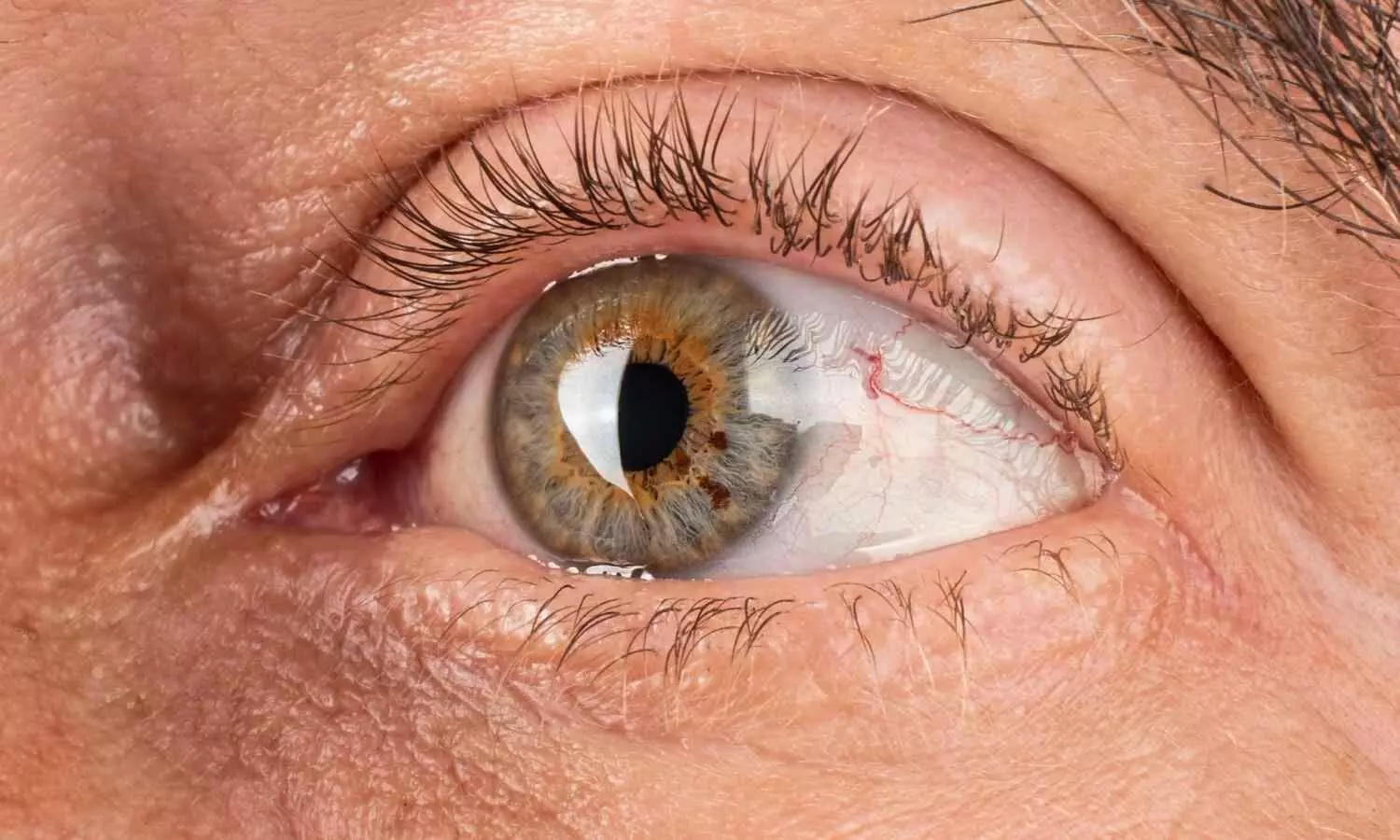 FDA Approves Epioxa for treatment of Keratoconus