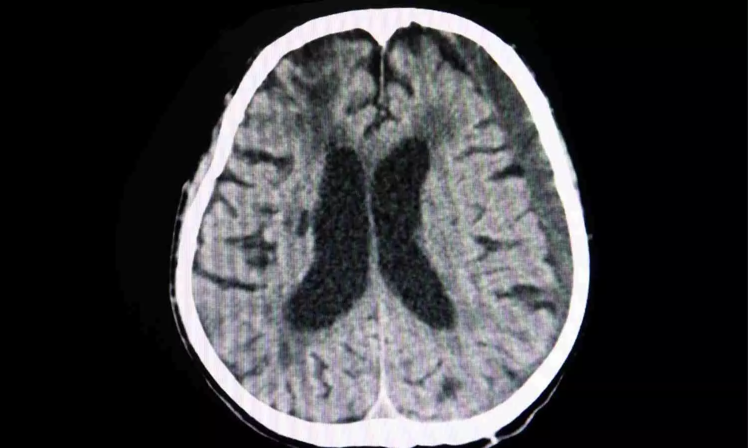 Study Finds No Clear Benefit of Early Surgery Over Conservative Care in Traumatic Acute Subdural Hematoma