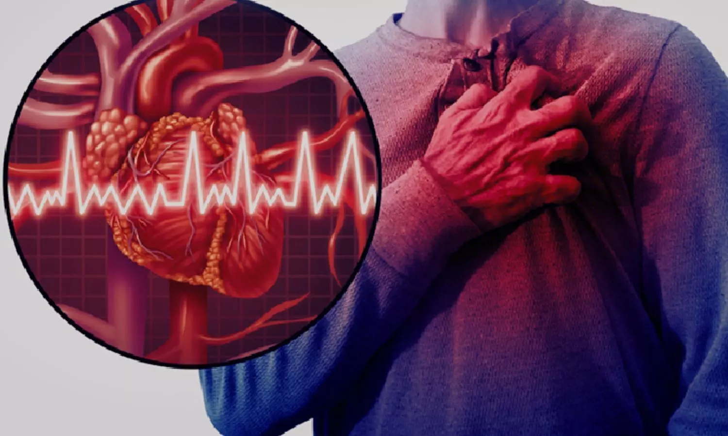 Ivabradine did not reduce occurrence of myocardial injury after noncardiac surgery: ESC Study