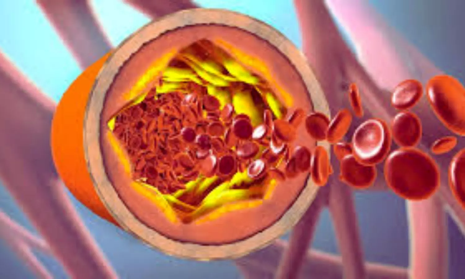 Intracranial Occlusion Not Linked to Higher Stroke Recurrence, suggests study