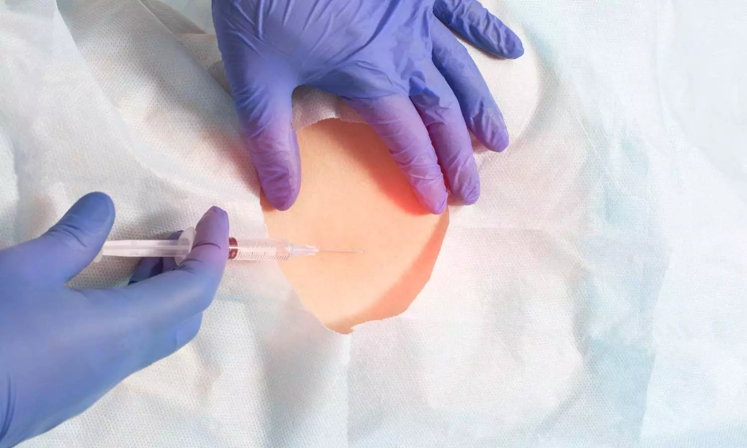 Epidural Analgesia Lowers Risk of Severe Perineal Tears in First-Time Mothers: Study