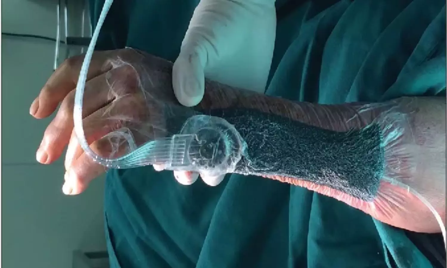 Vacuum Sealing Drainage Enhances Recovery in Severe Fournier’s Gangrene Cases: Study