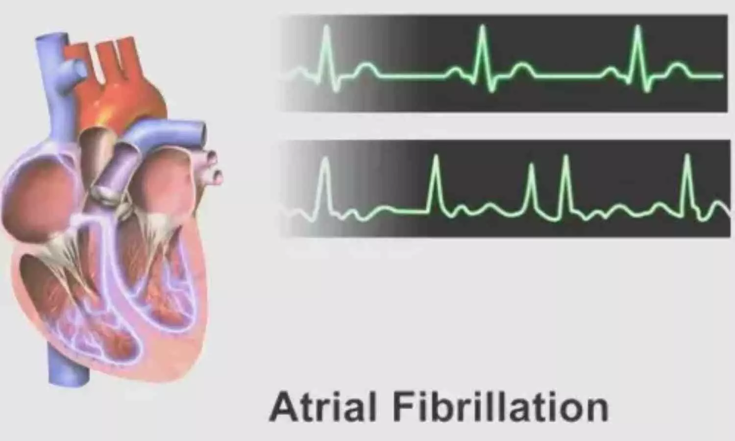 Living in a food desert doubles stroke risk for patients with atrial fibrillation, study finds
