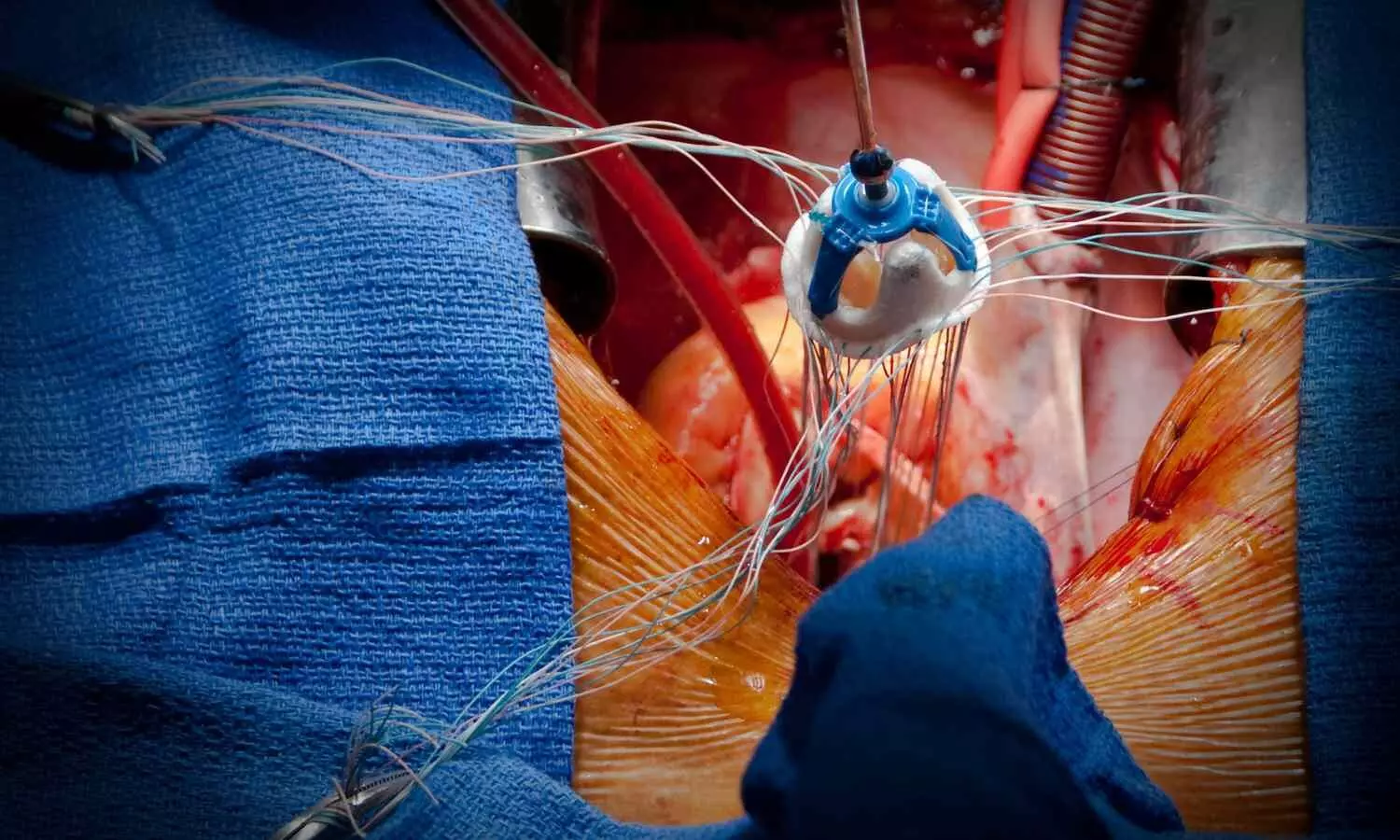 New Study identifies early signs of valve failure one year after TAVI, raising durability concerns in younger patients