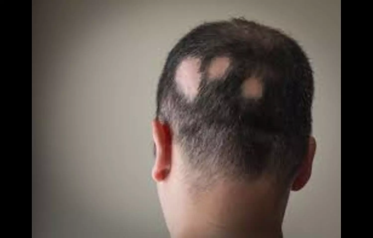 Upadacitinib Shows Safety and Efficacy in Adolescents with Severe Alopecia Areata: Study