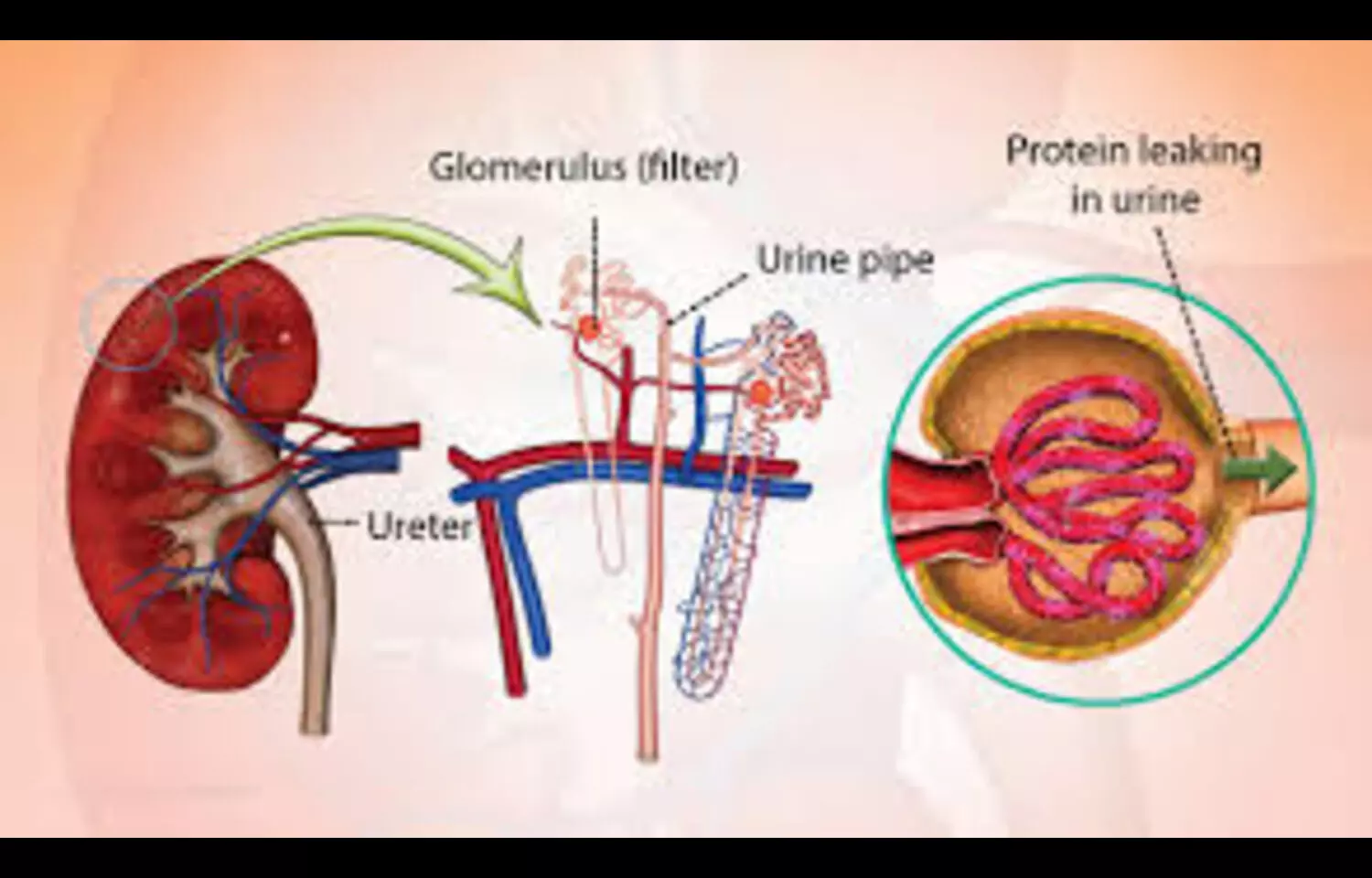 High UBUR Independent Predictor of Proteinuria Remission in Nephrotic Syndrome, suggests study