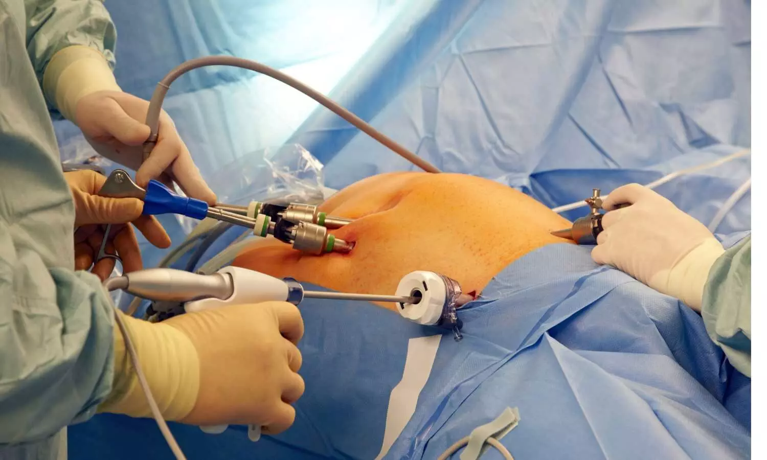 Bariatric Surgery Cuts Risk of Diabetes, Hypertension, and Other Metabolic Diseases: JAMA