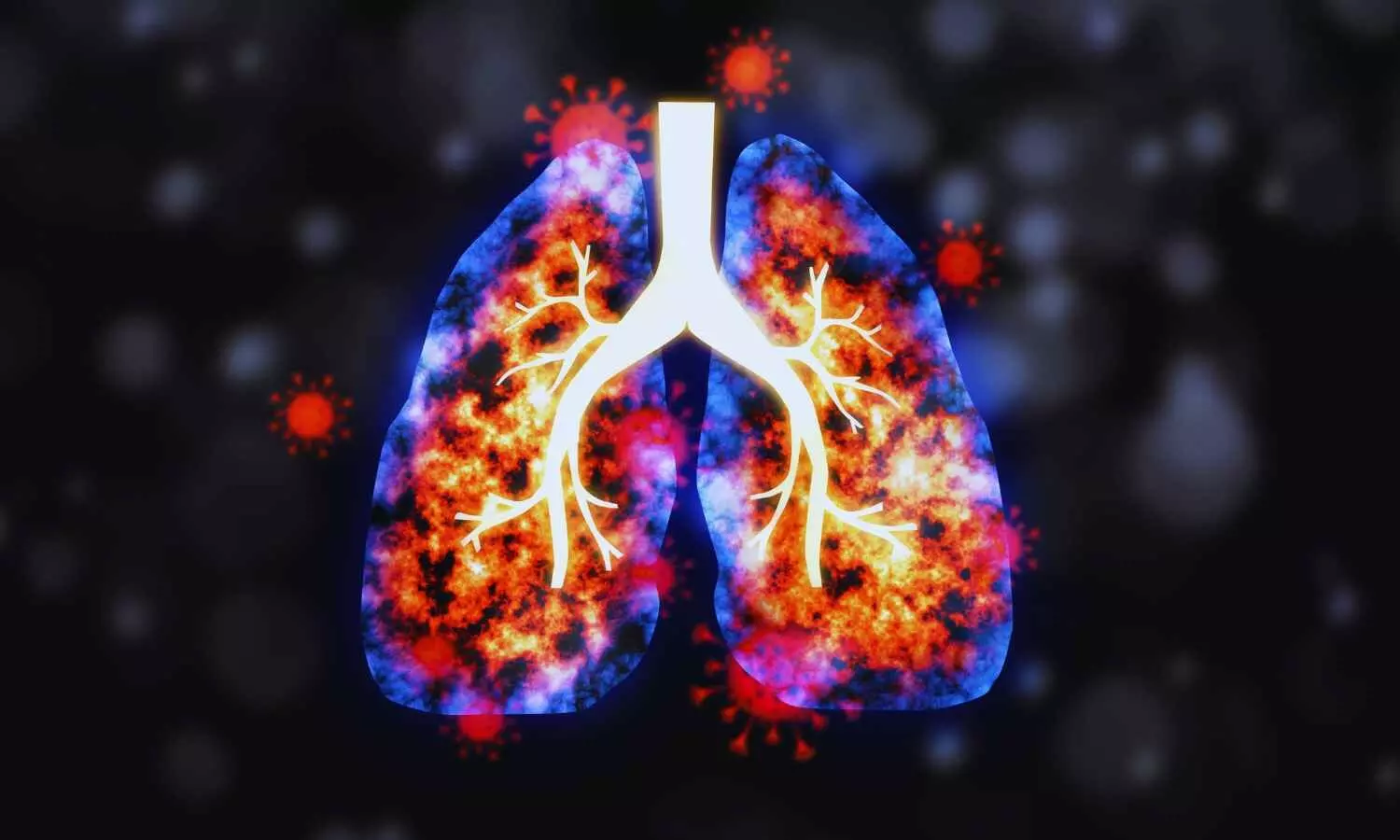 Rheumatoid arthritis-associated lung disease significantly increase risk of serious infection: Study