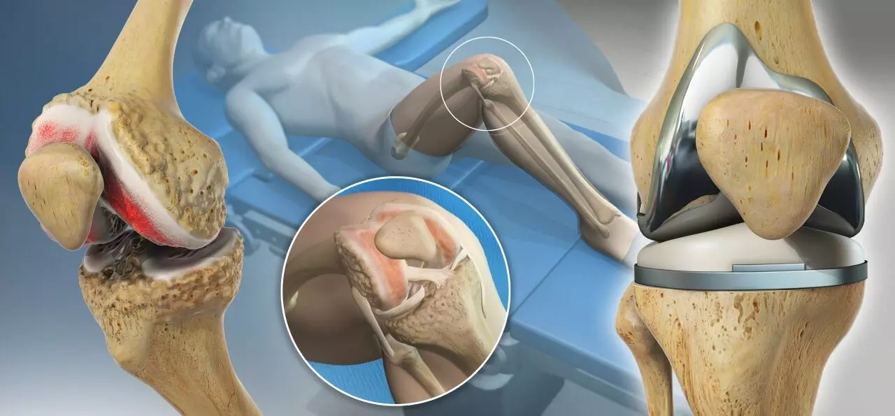 Personalized kinematic total knee arthroplasty in Indian population results in high satisfaction rates: study
