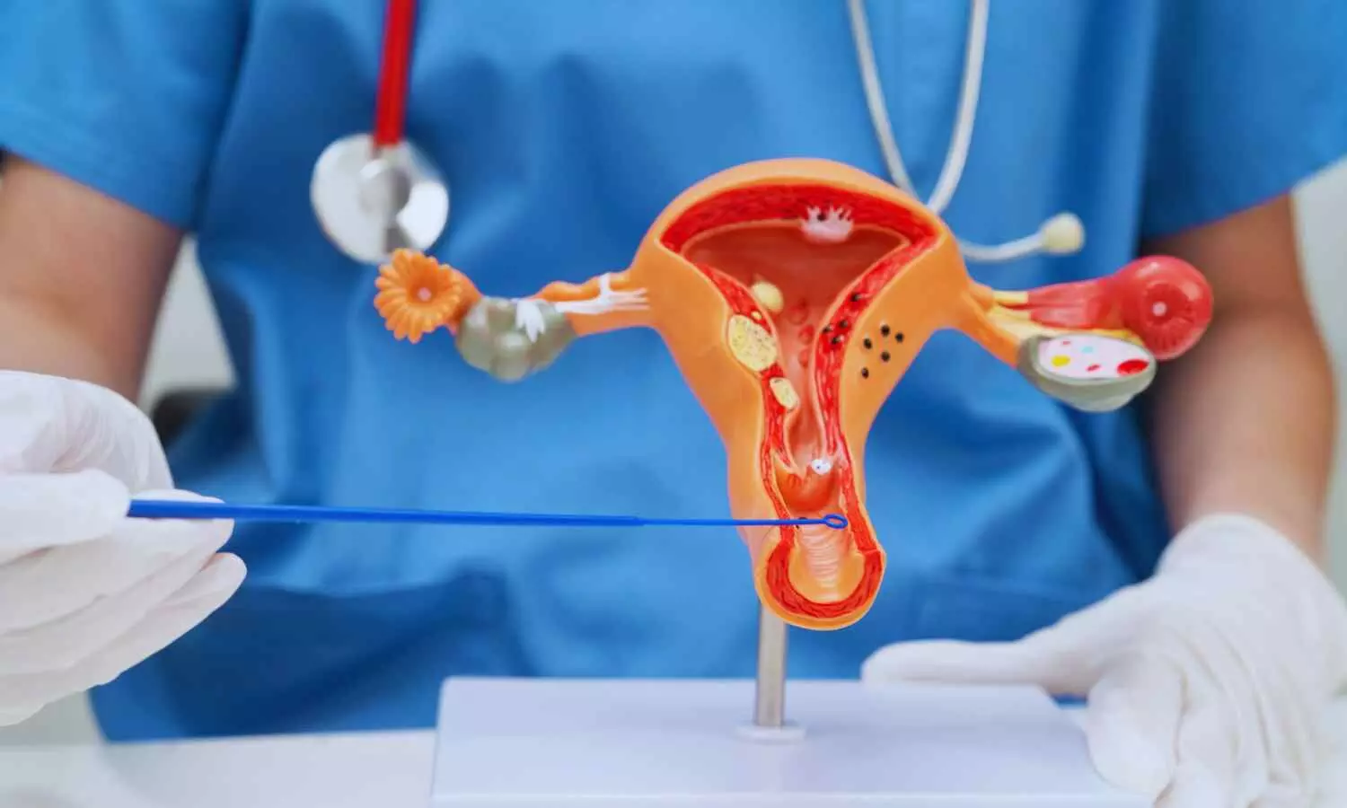 FDA Grants Approval to intrauterine device for Preventing Uterine Adhesions