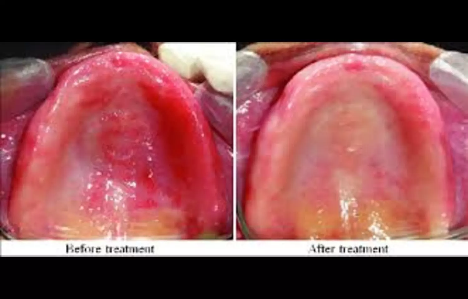 Topical Curcumin May Reduce Candida in Denture Stomatitis: Study