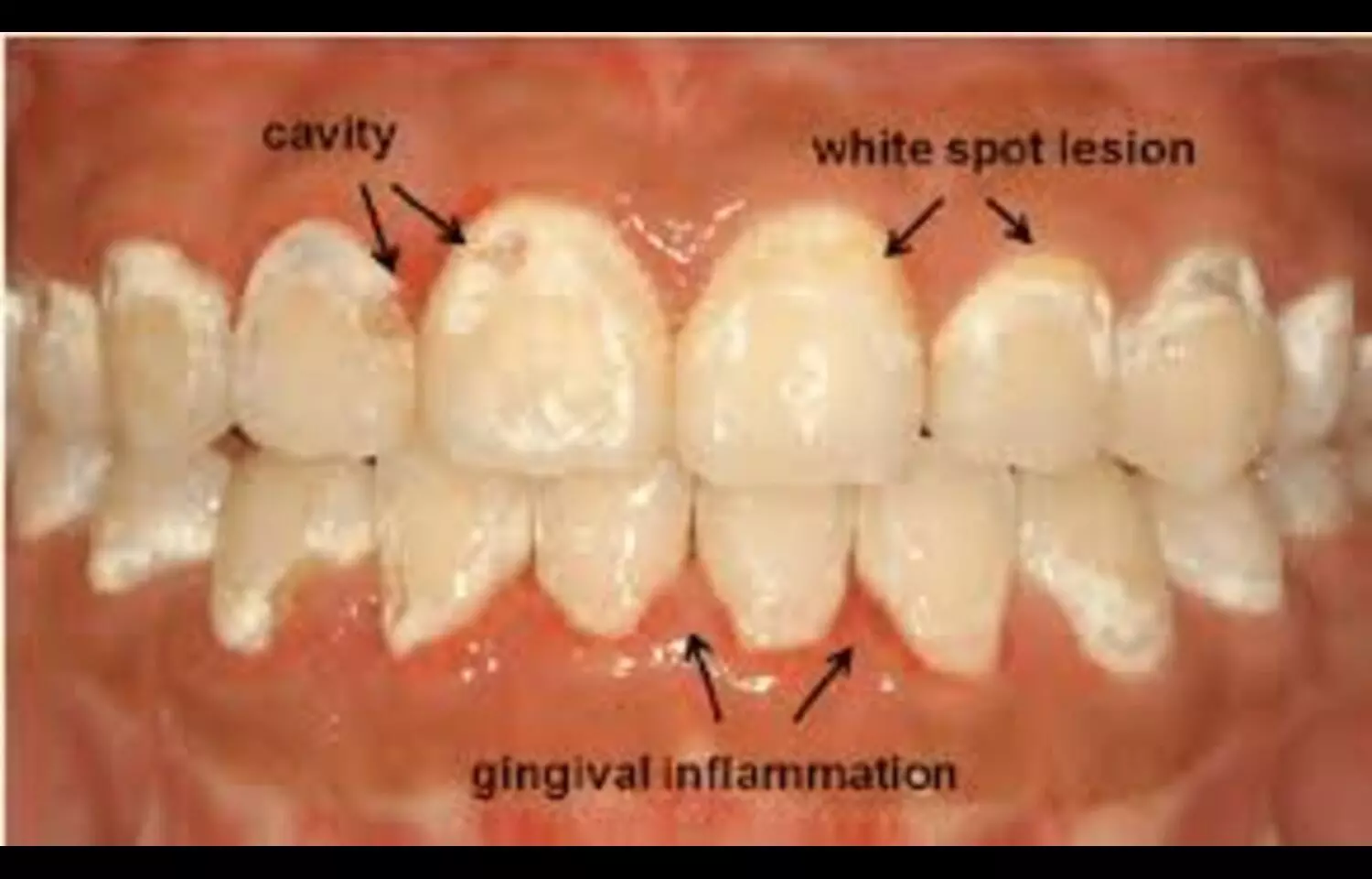 White Spot Lesions may Show Higher hydrogen peroxide Permeability and Poorer Whitening Results: Study