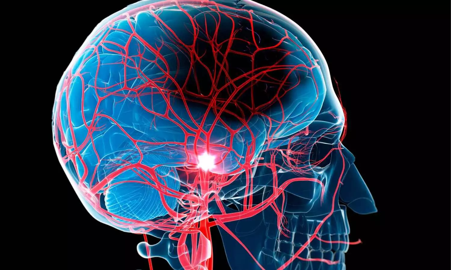 Anticoagulant Monotherapy alone, best for Stroke Prevention in AF with Atherosclerosis: JAMA