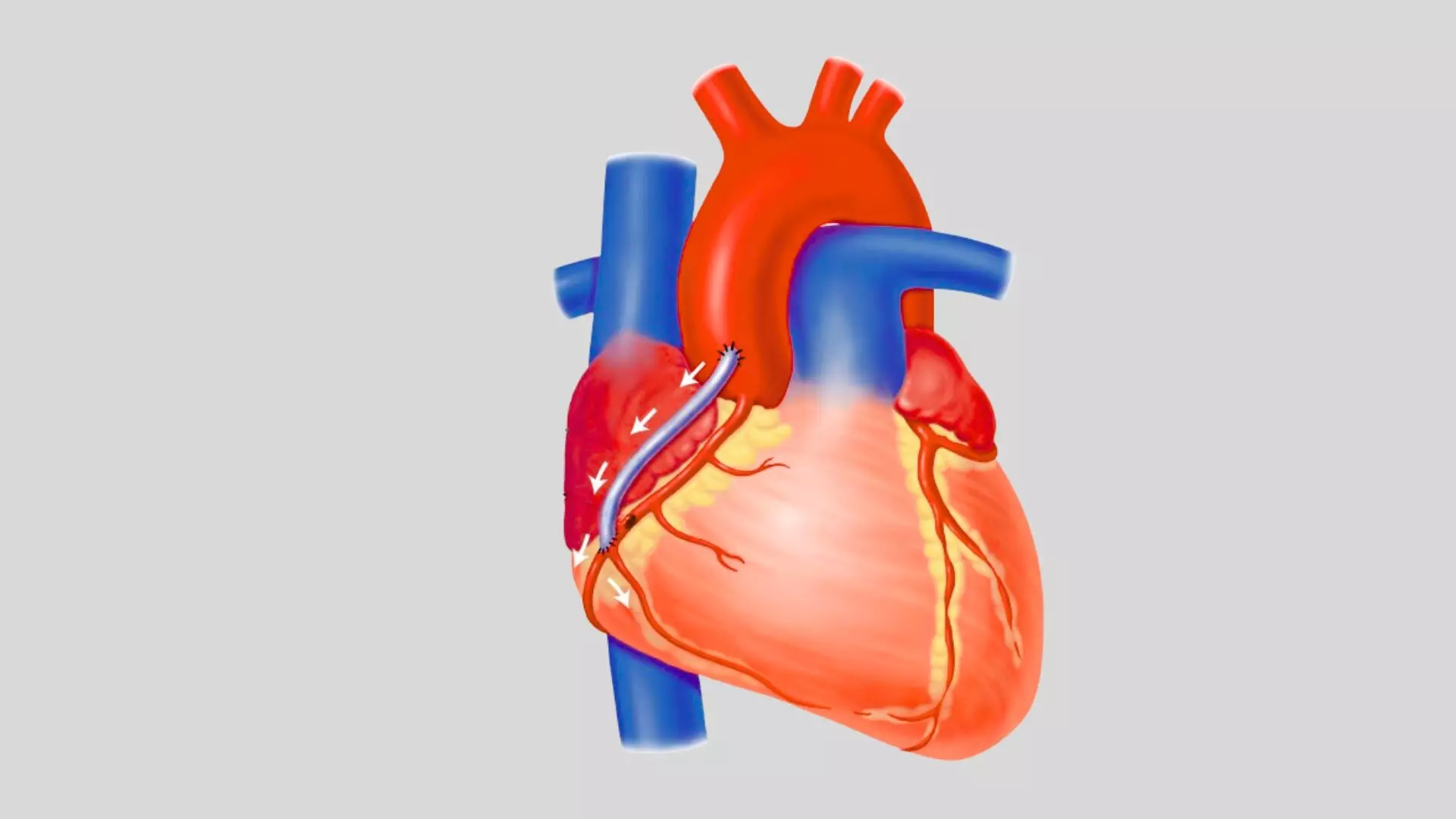 Saphenous Vein Graft PCI Better than Native Vessel PCI in Post-CABG Patients: PROCTOR Trial, TCT 2025