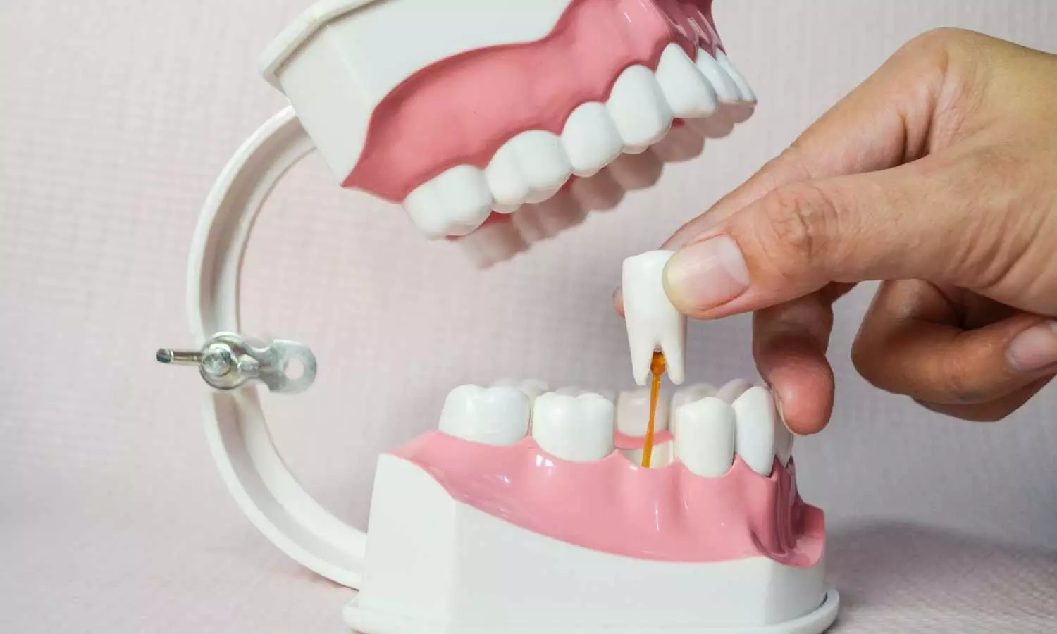 Tooth Loss Significantly Increases Stroke Risk in Adults, suggests study
