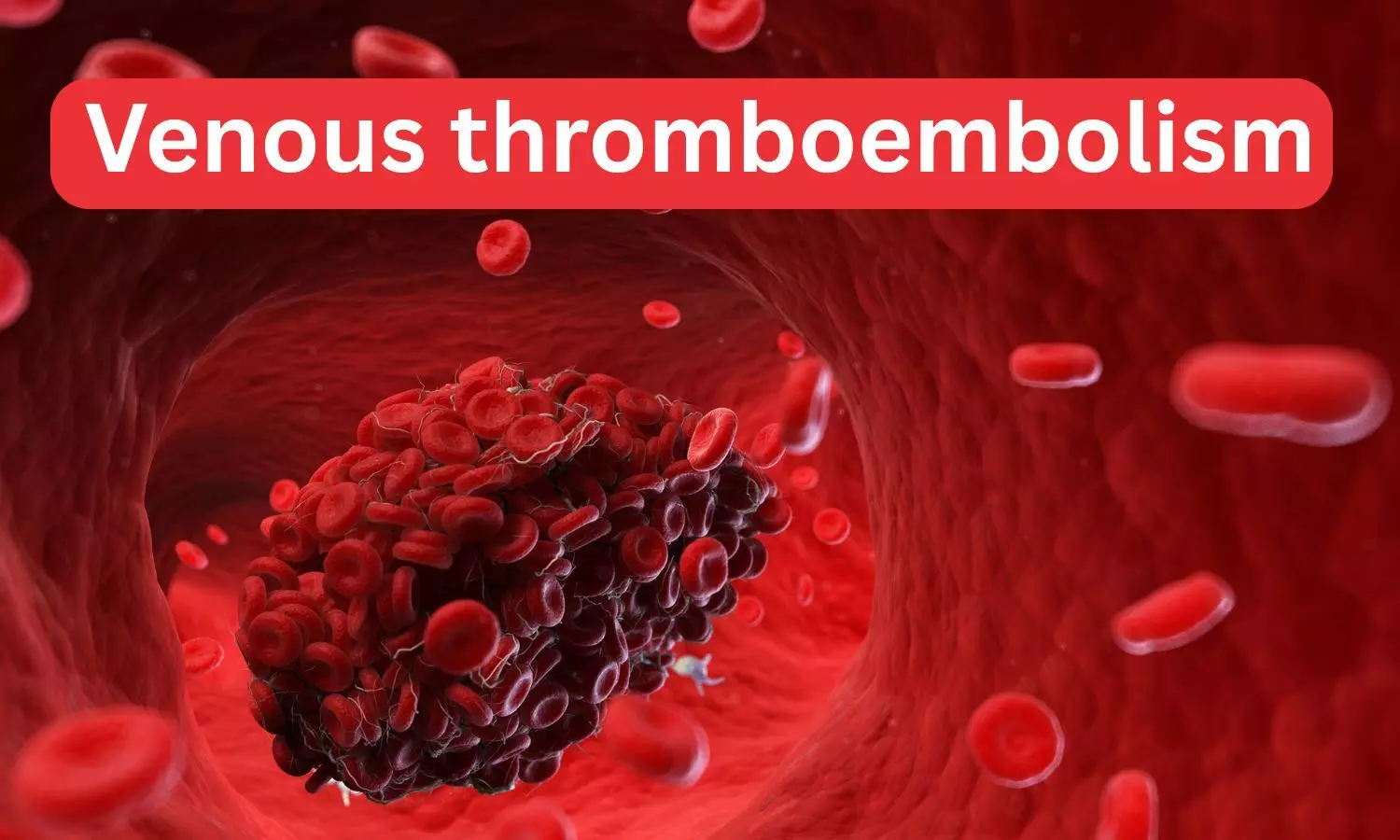 Delayed Diagnosis of Venous Thromboembolism Linked to Higher 30-Day Mortality, Study Finds