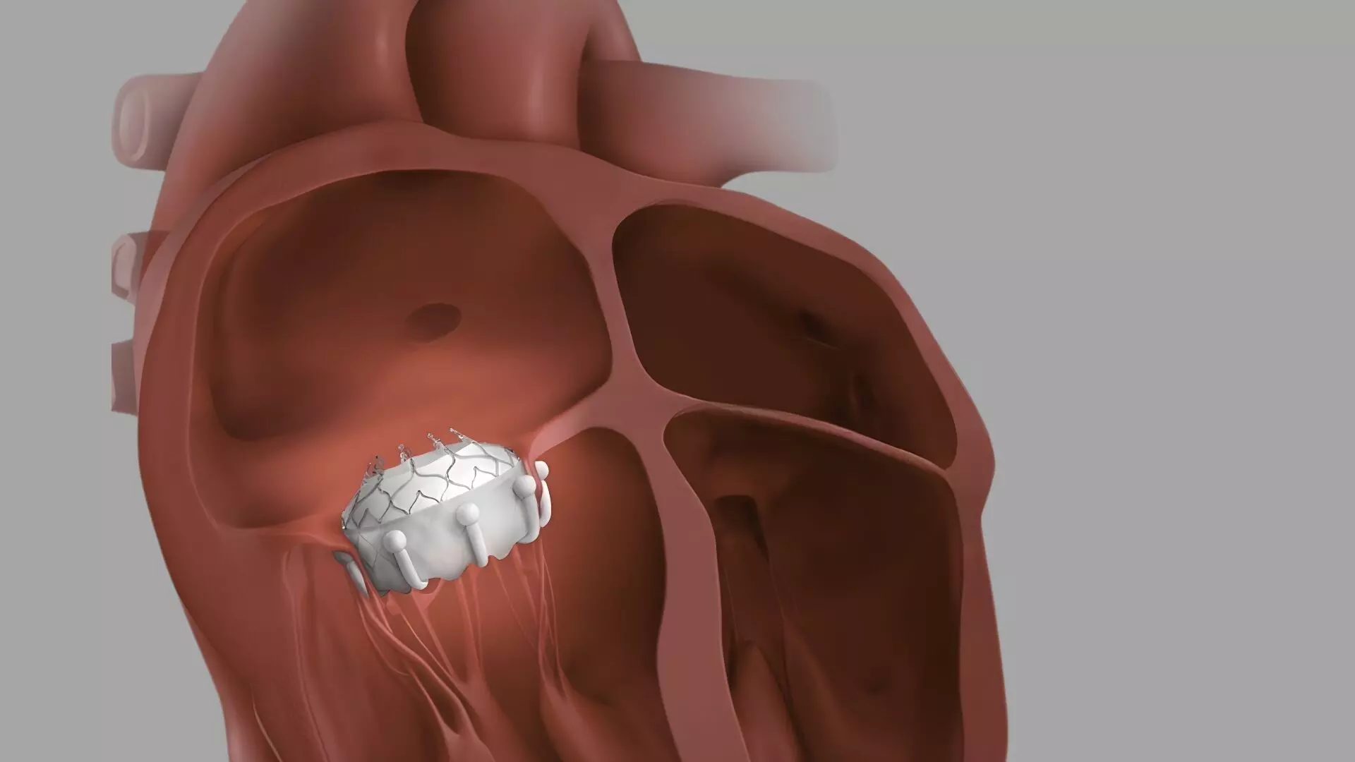 EVOQUE Transcatheter Tricuspid Valve Replacement (TTVR) Demonstrates Favorable Real-World Outcomes: Early U.S. Experience Confirms Safety, Effectiveness, and Quality-of-Life Gains