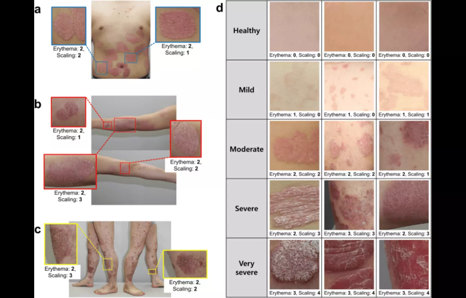 DMF Effectively Manages Moderate-to-Severe Psoriasis in Real-World Study