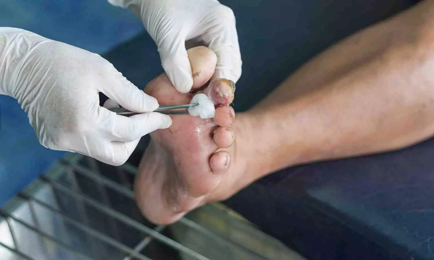Botanical-Based Hydrogel Promising in Treating Diabetic Foot Ulcers, Finds New Study