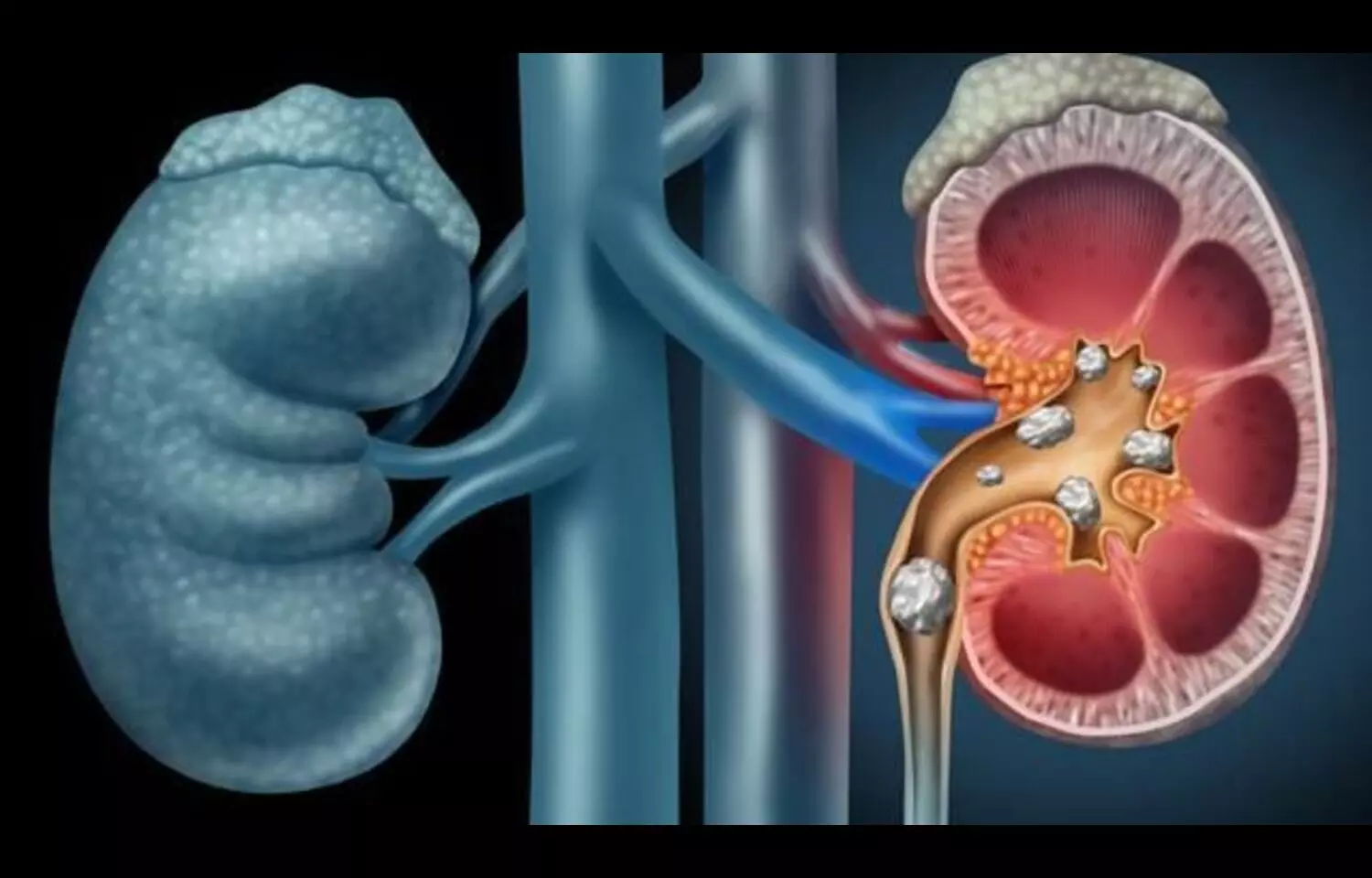 Rheumatoid Arthritis Patients Face Higher Risk of Kidney Stones: Study