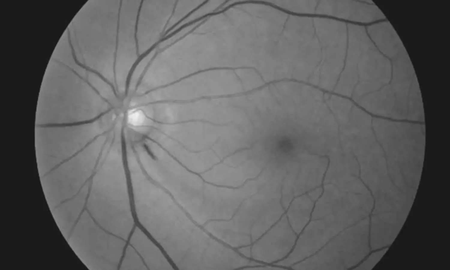 Nocturnal Blood Pressure Dips Linked to Rapid Central Vision Loss in Normal-Tension Glaucoma: Study