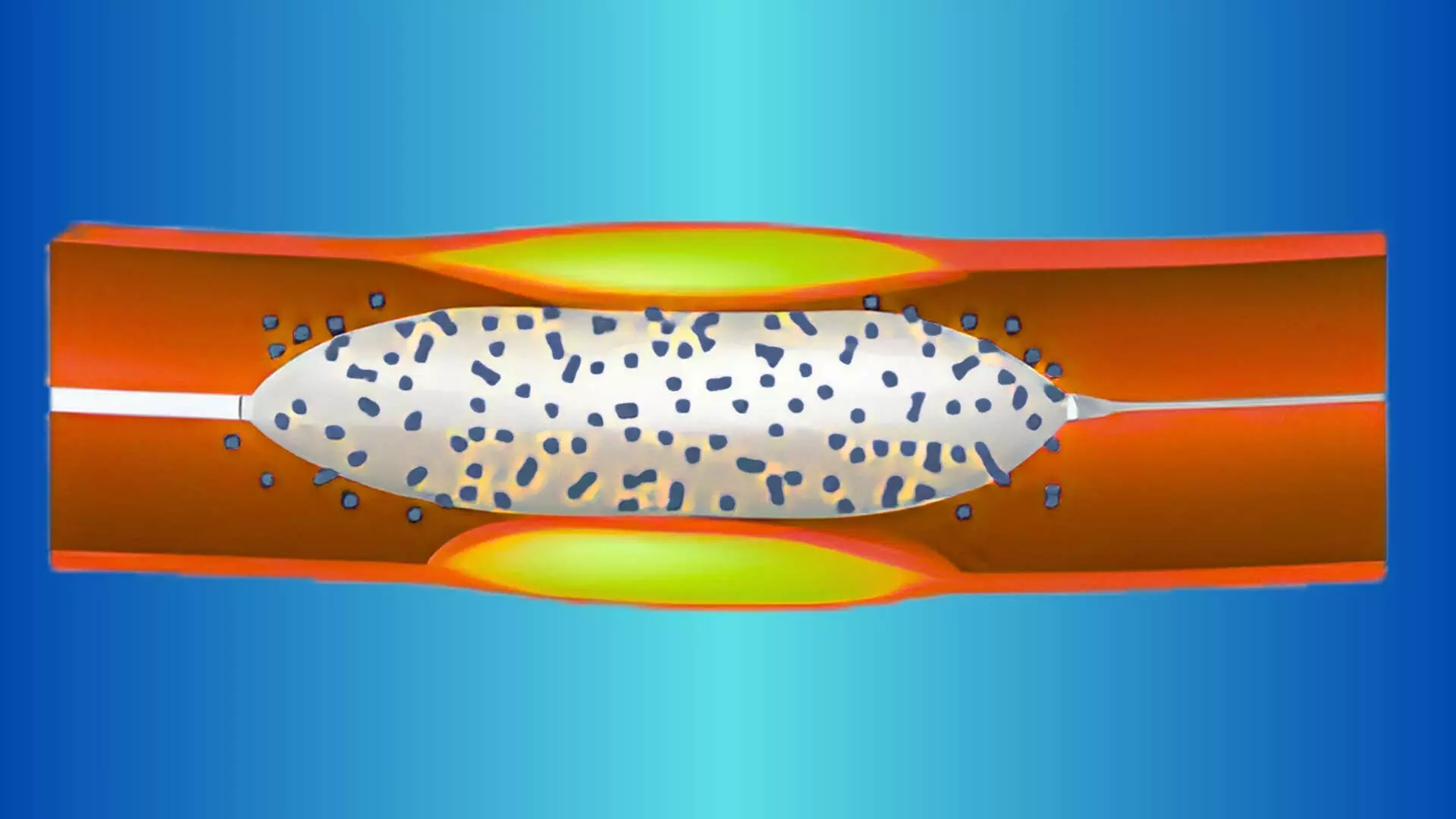 TCT 2025: OCVC-BIF Trial Compares Drug-Coated Balloon Versus Conventional Balloon for Treatment of Side Branches in Coronary Bifurcation Lesions