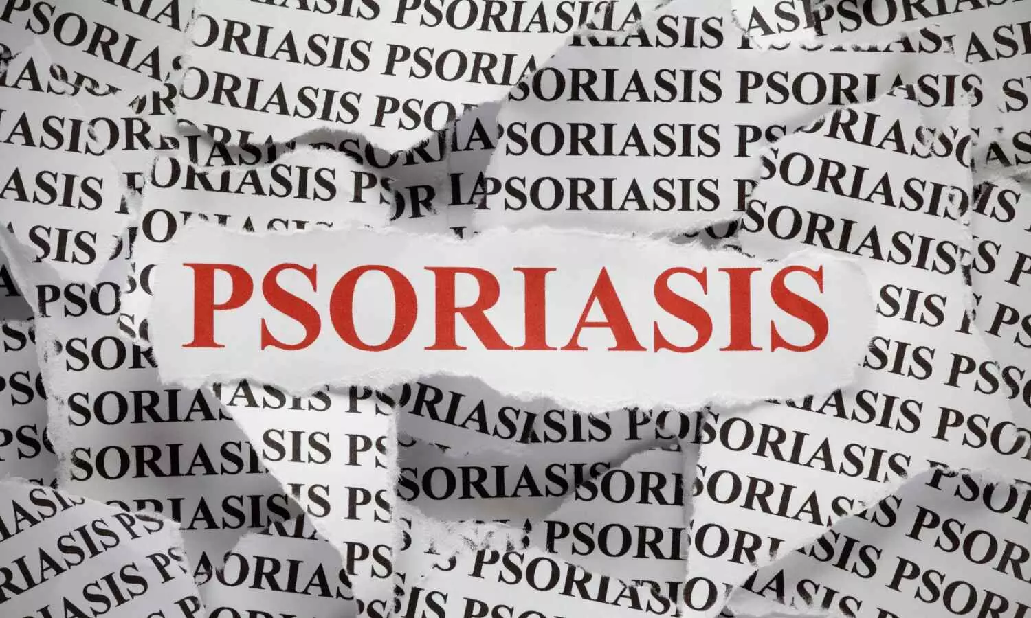 POSITIVE Trial: Tildrakizumab Significantly Improves Quality of Life in Psoriatic Disease