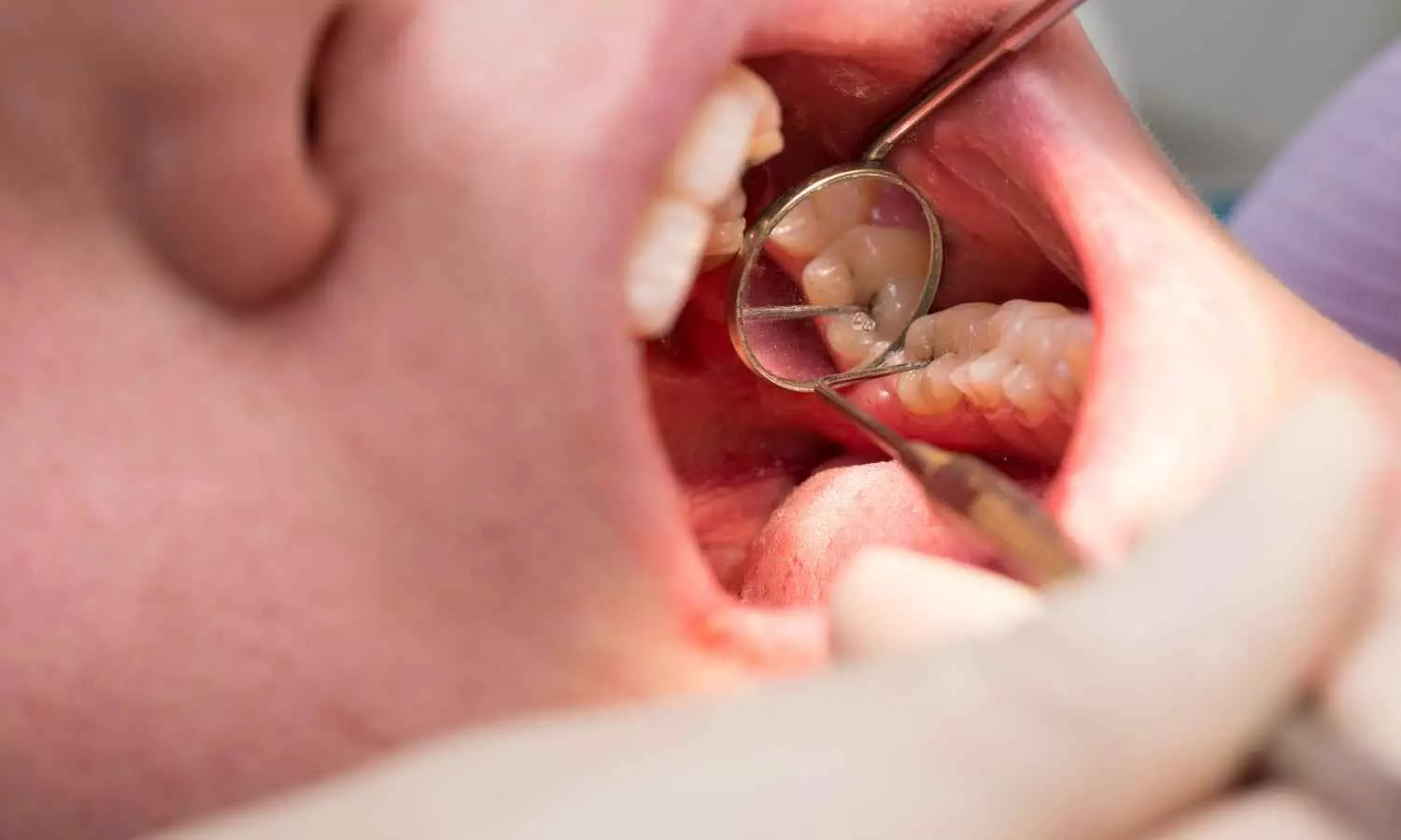 Predicta Bioactive Bulk as effective as 3M Filtek Bulk Fill in Class V Caries Restoration, Suggests Study