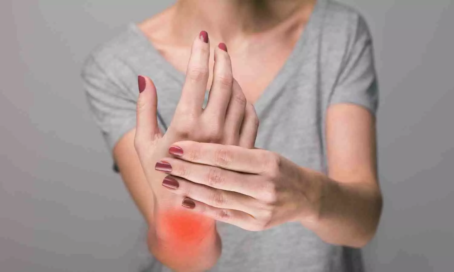 Rheumatoid Arthritis Linked to Higher Risk of Kidney Stones, NHANES Study Finds