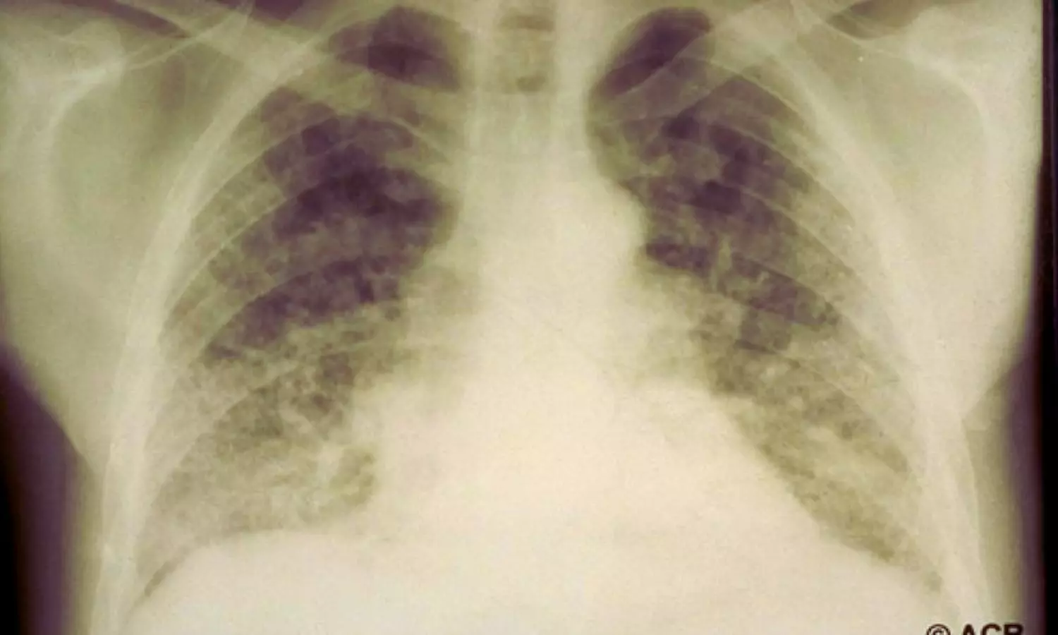 Interstitial Lung Disease Significantly Increases Risk of All Lung Cancer Types: Study