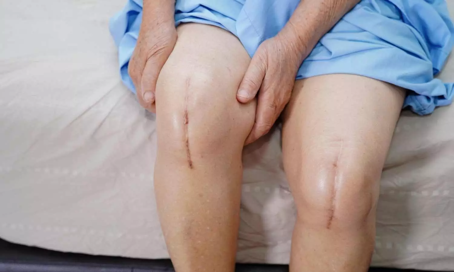 Stay Moving: Exercise After Knee Replacement Cuts Heart and Stroke Risks, Study Suggests
