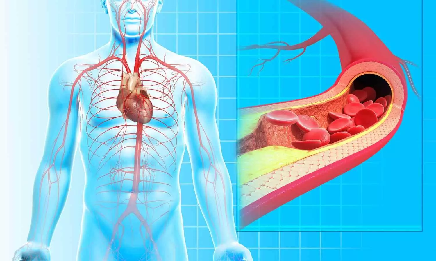 Drug-coated devices do not improve outcomes in patients with peripheral artery disease: ESC Study