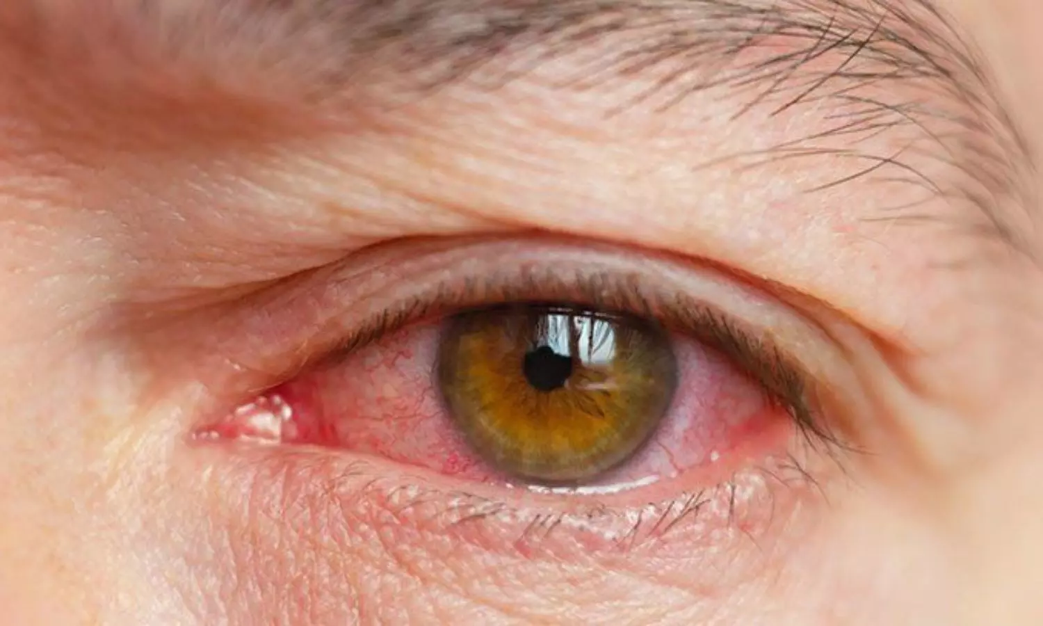 Meta-Analysis Reveals Higher Risk of Dry Eye in Patients with Inflammatory Bowel Disease