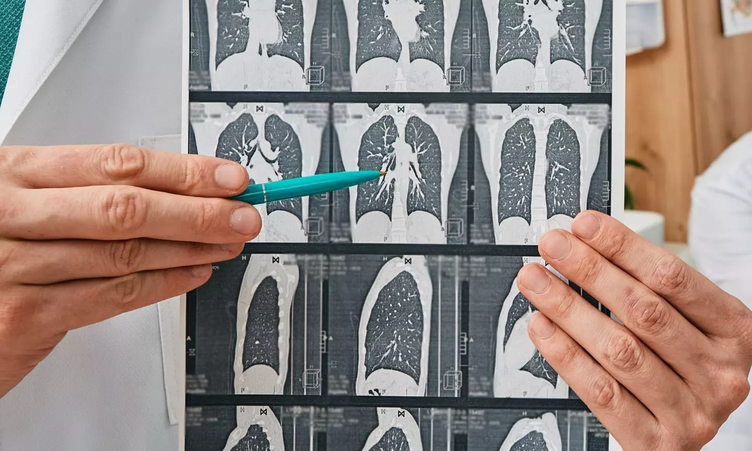 Emphysema at CT lung screening increases death risk in asymptomatic adults: Study