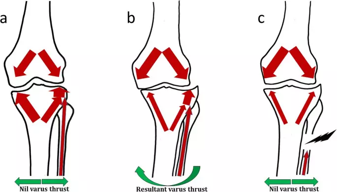 PFO effectively alleviates pain and enhances joint function in patients with medial compartment OA: study