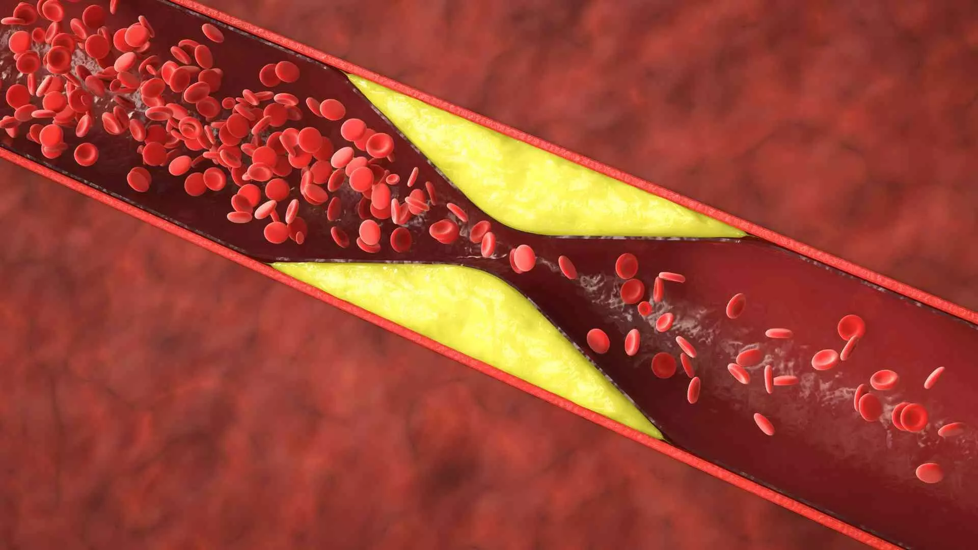 VICTORY Trial Confirms Non-Inferiority of High-Pressure Balloon vs Intravascular Lithotripsy (IVL) in Calcified Coronary Lesions: Results from Late-Breaking Presentation at TCT 2025