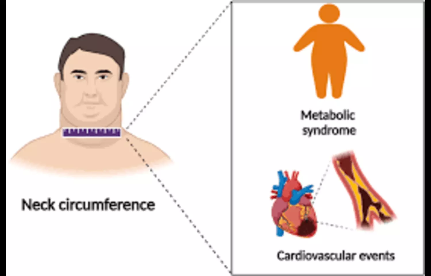 Neck Circumference a Practical Screening Tool for Metabolic Syndrome, suggests Study