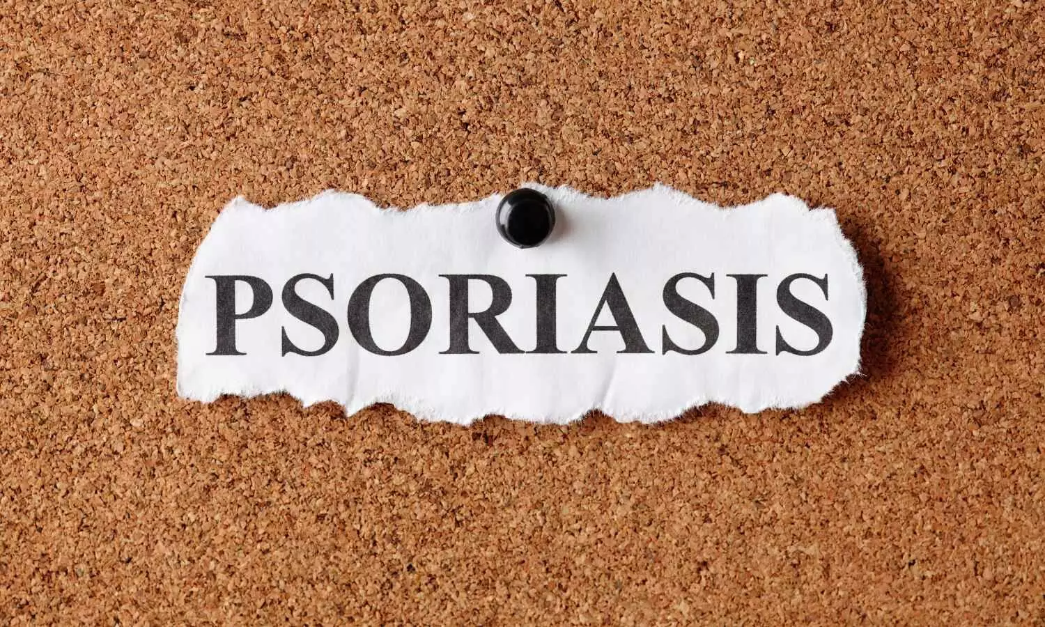 Psoriasis Linked to Higher Risk of Age-Related Macular Degeneration: Study