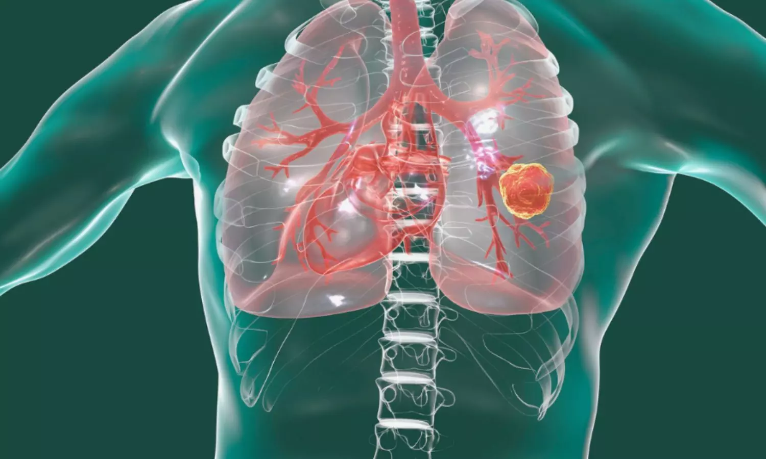 Robot-Assisted Bronchoscope Helps Diagnose Hard-to-Reach Tiniest Lung Tumours: ERS Study