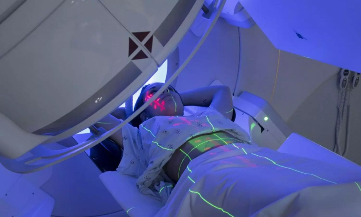 Adjuvant Radiotherapy or ET Lowers Locoregional Recurrence Rates Risk in Early-Stage Breast Cancer: JAMA