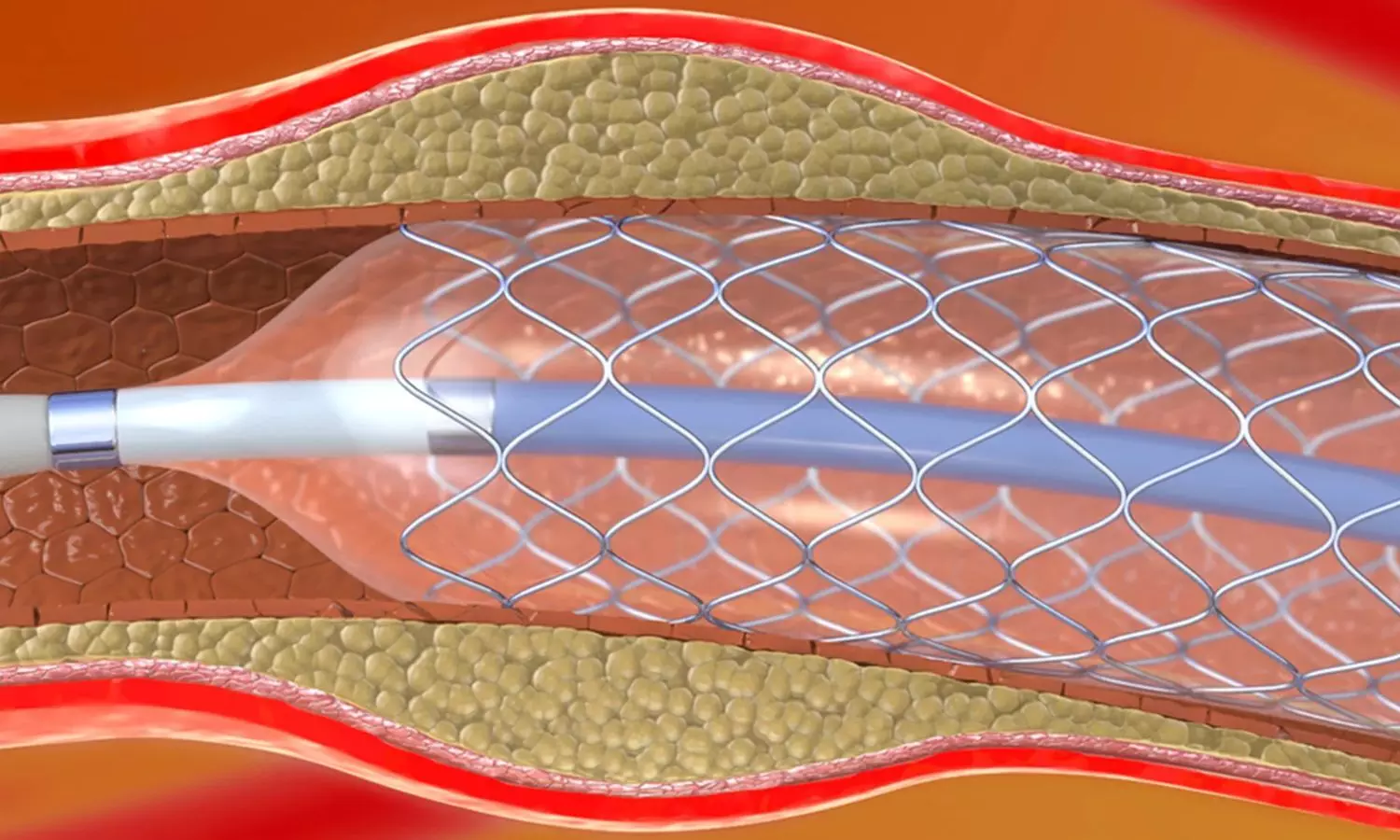 TyG and TyG-BMI Indices Predict NAFLD Risk in PCI Patients: Study