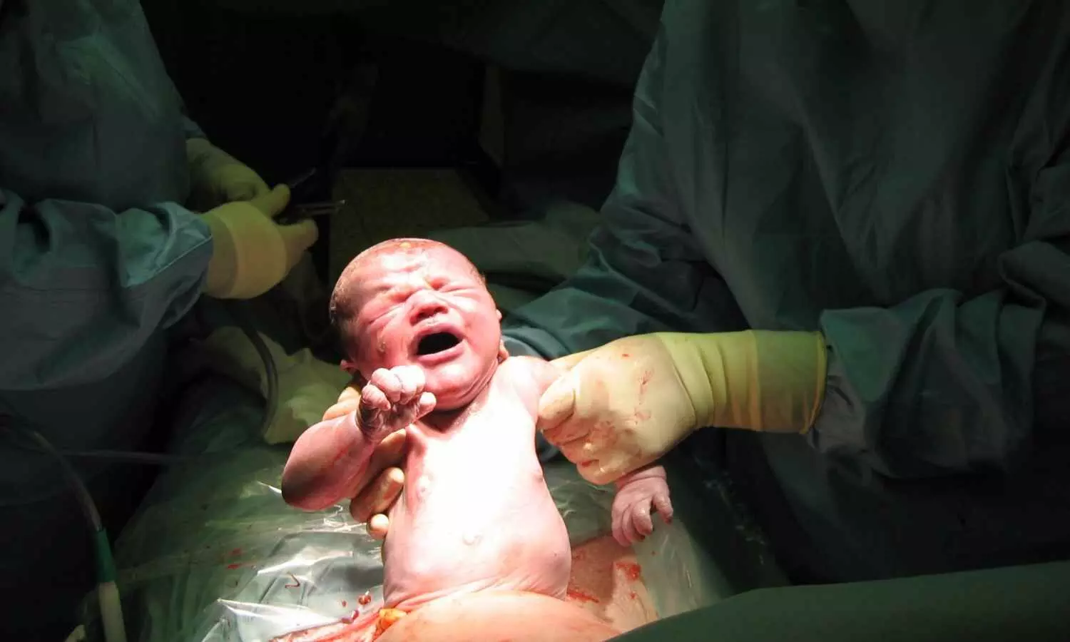 Study highlights risks of Caesarean births to future pregnancies