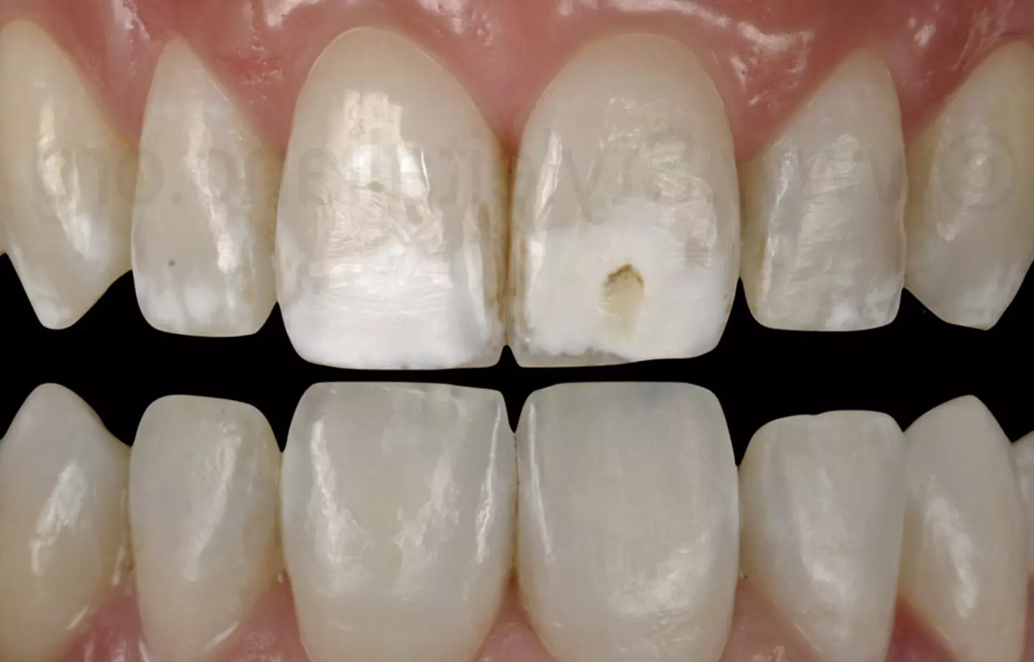 Silica Particle Size and Concentration Critically Influence Dental Resin Performance: Study